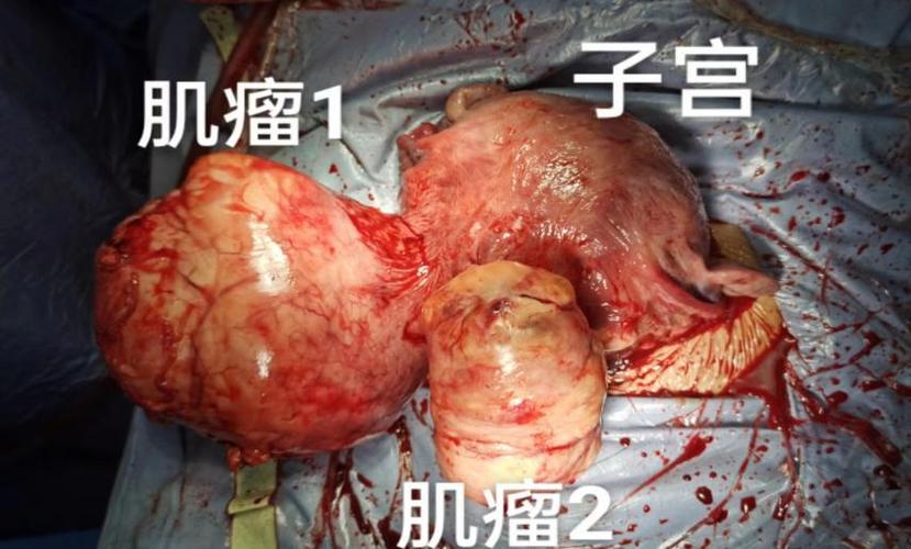 和平区妇婴医院巨大子宫肌瘤治疗_沈阳市和平区妇婴医院子宫肌瘤手术_沈阳省妇婴医院