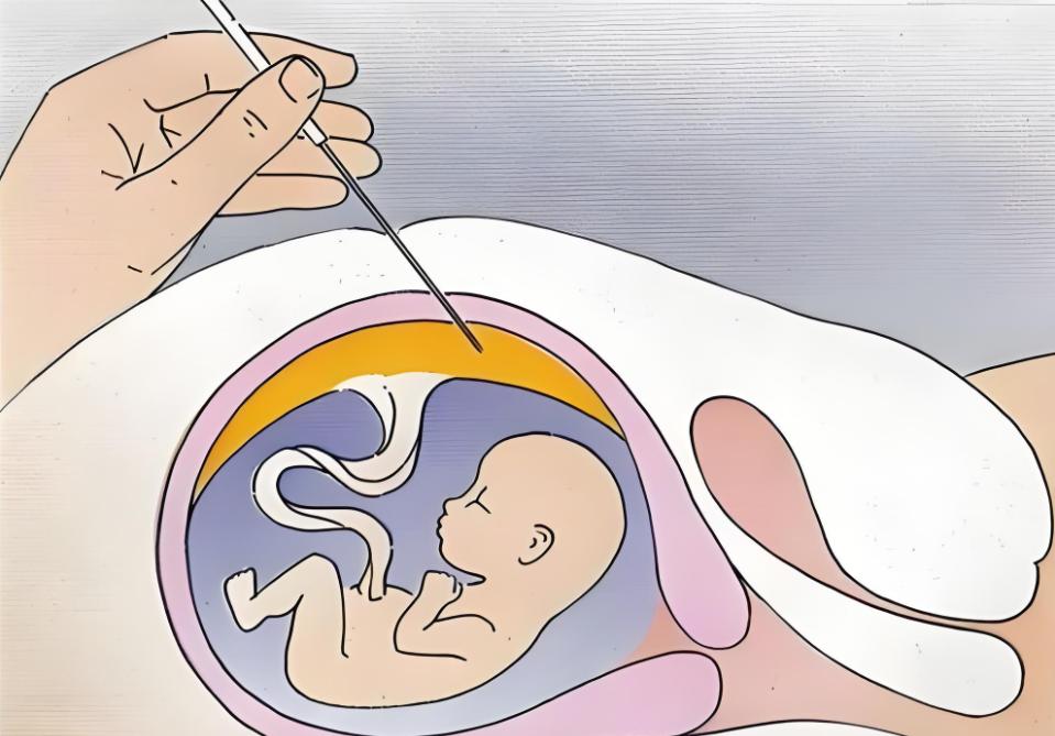 沈阳市妇婴医院产前诊断中心_沈阳省妇婴医院_绒毛穿刺术孕早期诊断